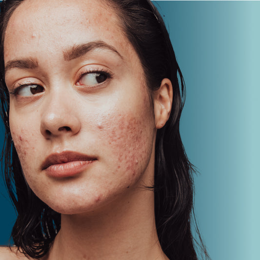 Anti-Acne 4-week course